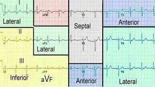 Infarto Agudo del Miocardio con Elevación del Segmento ST