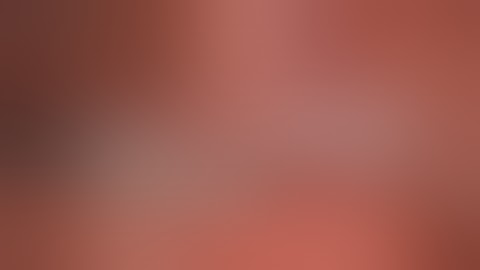 Perforated appendix base - Laparoscopic Appendectomy