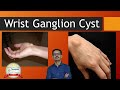 Ganglion Cyst of Wrist. Small Lump over Wrist