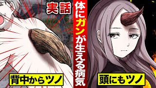 【実話】ガンの究極系。背中や頭から…巨大なツノが生えた人間がいる。