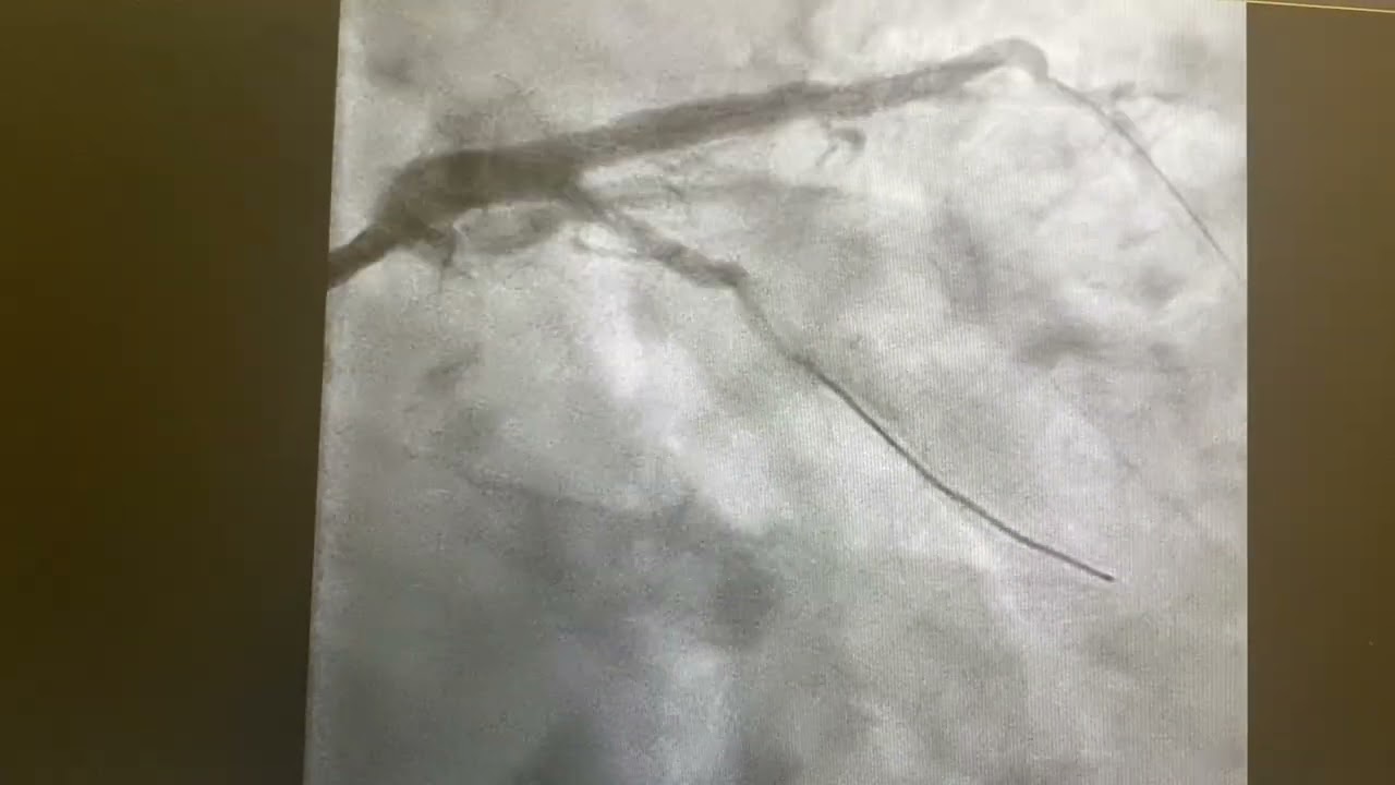 Left main coronary Intervention 