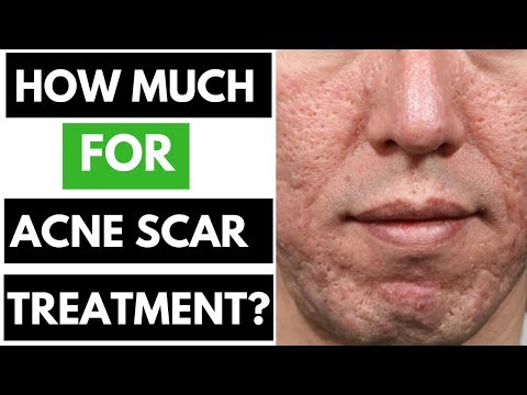 Acne Scar Treatment Cost? (SHOCKING PRICES REVEALED) 😲 Laser | Injection | Punch Excision