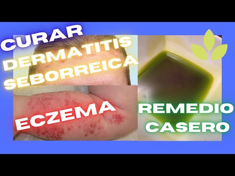 Vídeo: Aloe Vera Para Eczema: Benefícios, Usos, Segurança Para Adultos E Crianças