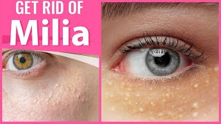 GET RID OF MULTIPLE MILIA UNDER THE EYES AND FACE NATURALLY AT HOME || QUICK MILIA TREATMENT