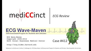 Sinus Rhythm with Atrial Bigeminy (ECG Wave-Maven) Case #412