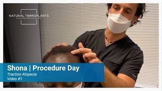 Military Hair Loss and Traction Alopecia Hair Transplant Procedure Day | Dr. Blumenthal (Shona)