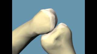 Hammertoe surgery