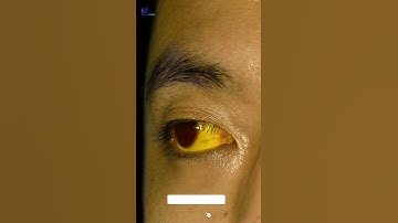 Triệu chứng K gan #Shorts