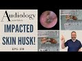 DEEP IMPACTED SKIN HUSK REMOVAL - EP518