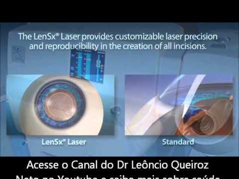 Cirurgia de catarata a laser - LENSX LASER SYSTEM da ALCON - YouTube