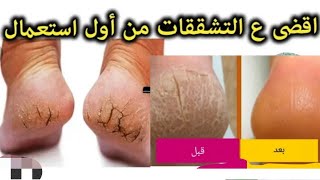 لو كعبك متشقق الحل في الاختراع ده هيخلي رجلك زي الاطفال