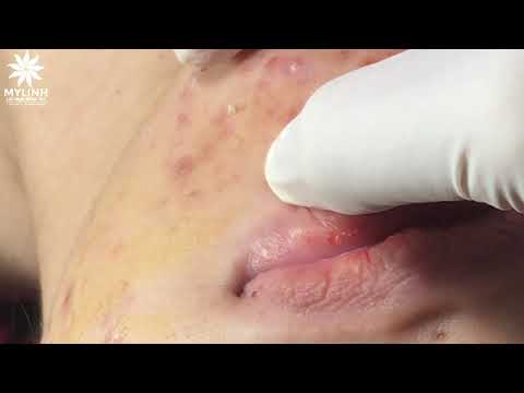 BLACKHEADS AND ACNE REMOVAL #52 | Lấy mụn ẩn dưới da, mụn đầu đen | 黑頭和粉刺去除 | 0934000075
