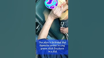 Closed Reduction | Greenstick Fracture both bones forearm | Short GA | Adamya hospital videos