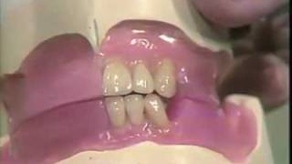 Setting Mandibular Anterior Teeth