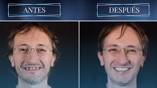 ANTES Y DESPUES | CARILLAS, IMPLANTES, INVISALIGN