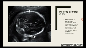 ¿Cuánto es lo normal de DBP?