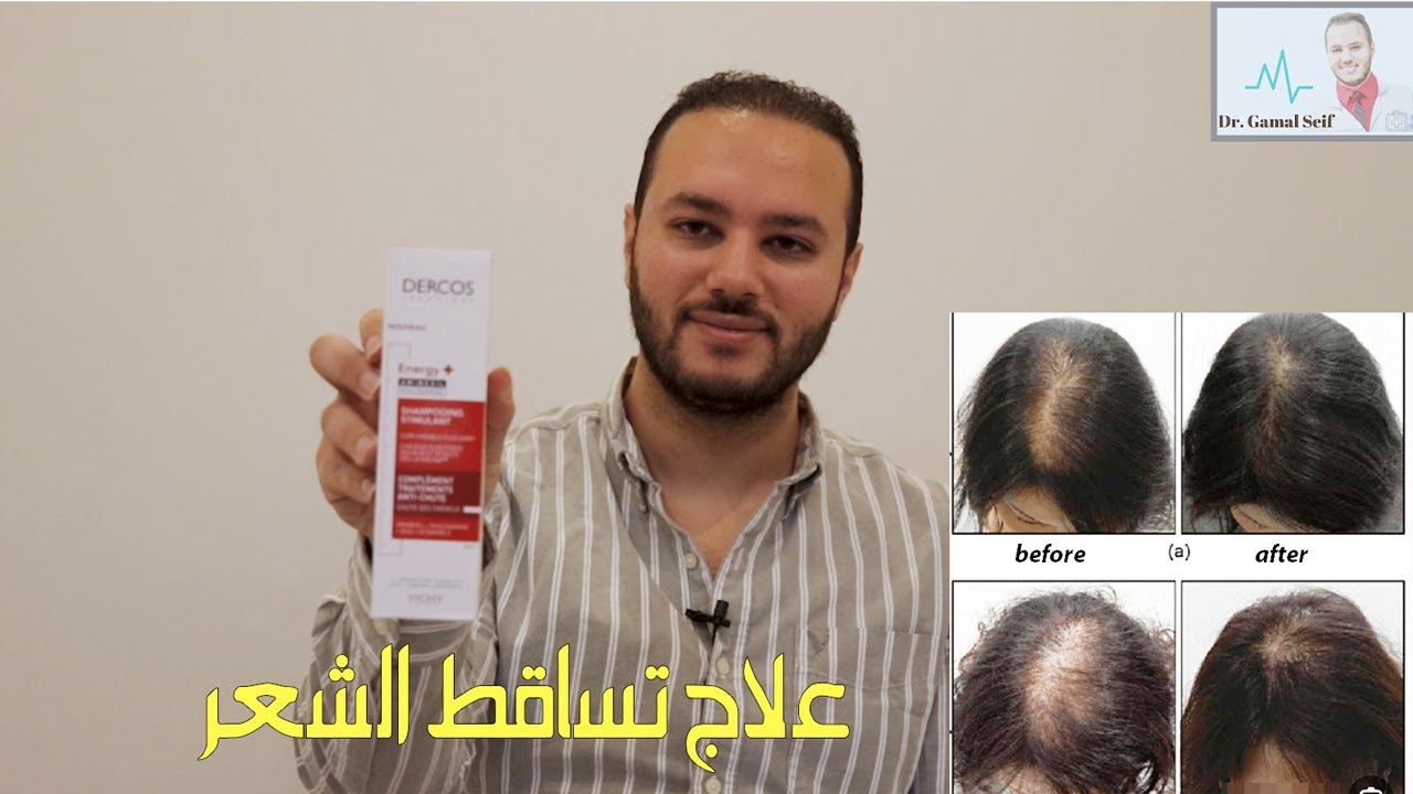 علاج تساقط الشعر | افضل شامبو و مكمل غذائي لعلاج تساقط الشعر