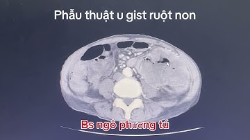 Phẫu thuật u gist ruột non