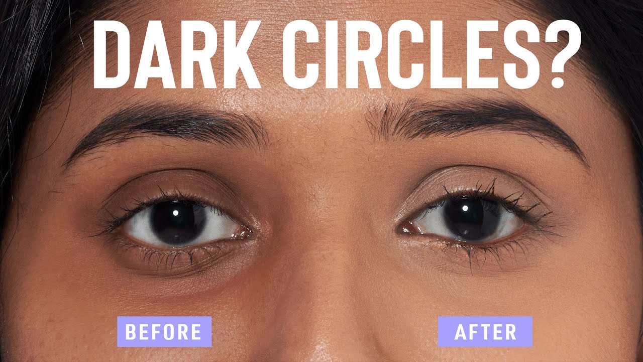 Home Remedies To Remove Dark Circles Quickly And Naturally Youtube