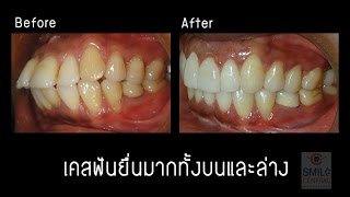 ฟันหน้ายื่น