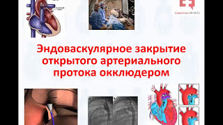 ОАП или открытый артериальный проток: эндоваскулярное закрытие и лечение окклюдером