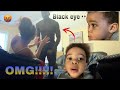 I Gave My Son A BLACK EYE To See How His Dad Would React!! *THIS HAPPENED*