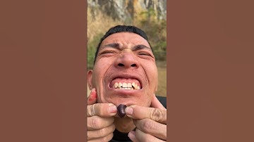 How I Cured a Bug Bite with Yogurt in the Wild Survival Hacks p465