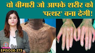 Scleroderma वो बीमारी जिसमें Skin पत्थर जैसी हो जाती है, कैसे बचें? | Sehat ep 373 screenshot 1