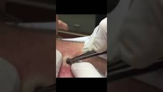 Extreme pimple popping , Blackhead removal , Blackheads extraction 2023