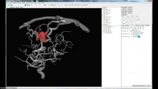 Arteriovenous Malformation (AVM) Decomposition