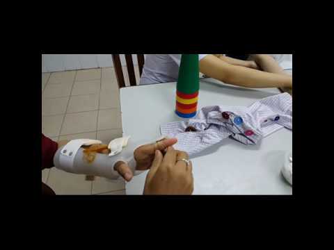 Nẹp hỗ trợ và điều trị cho Liệt thần kinh quay