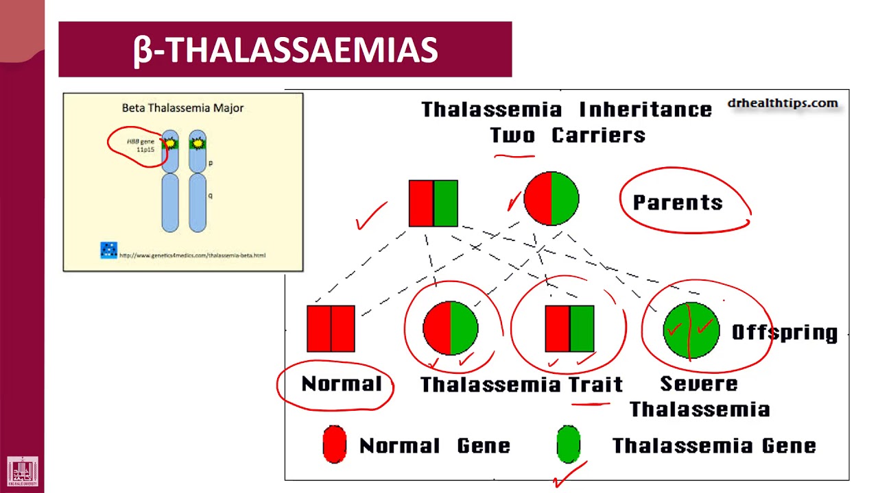 case study beta thalassemia major