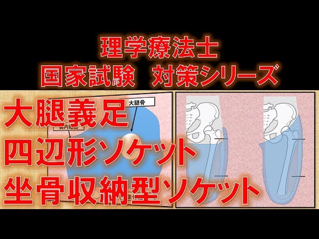 四辺形ソケット 坐骨収納型ソケット 大腿義足ソケットの種類と機能 No 116 理学療法士国家試験対策 シリーズ Youtube