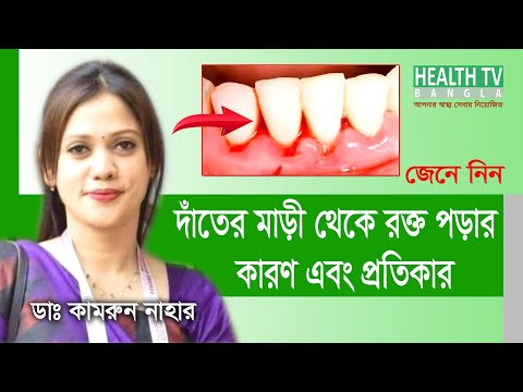 দাঁতের মাড়ি থেকে রক্ত পড়ার কারণ ও প্রতিকার | Causes and remedies for bleeding gums | Dr.Kamrun Nahar