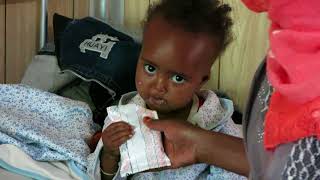 RUTF Ready to Use Therapeutic Food for malnourished childs in Gambo, Ethiopia