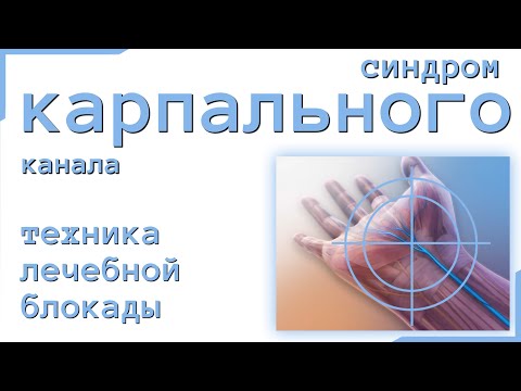 Видео: Синдром на карпалния лагсит при кучета