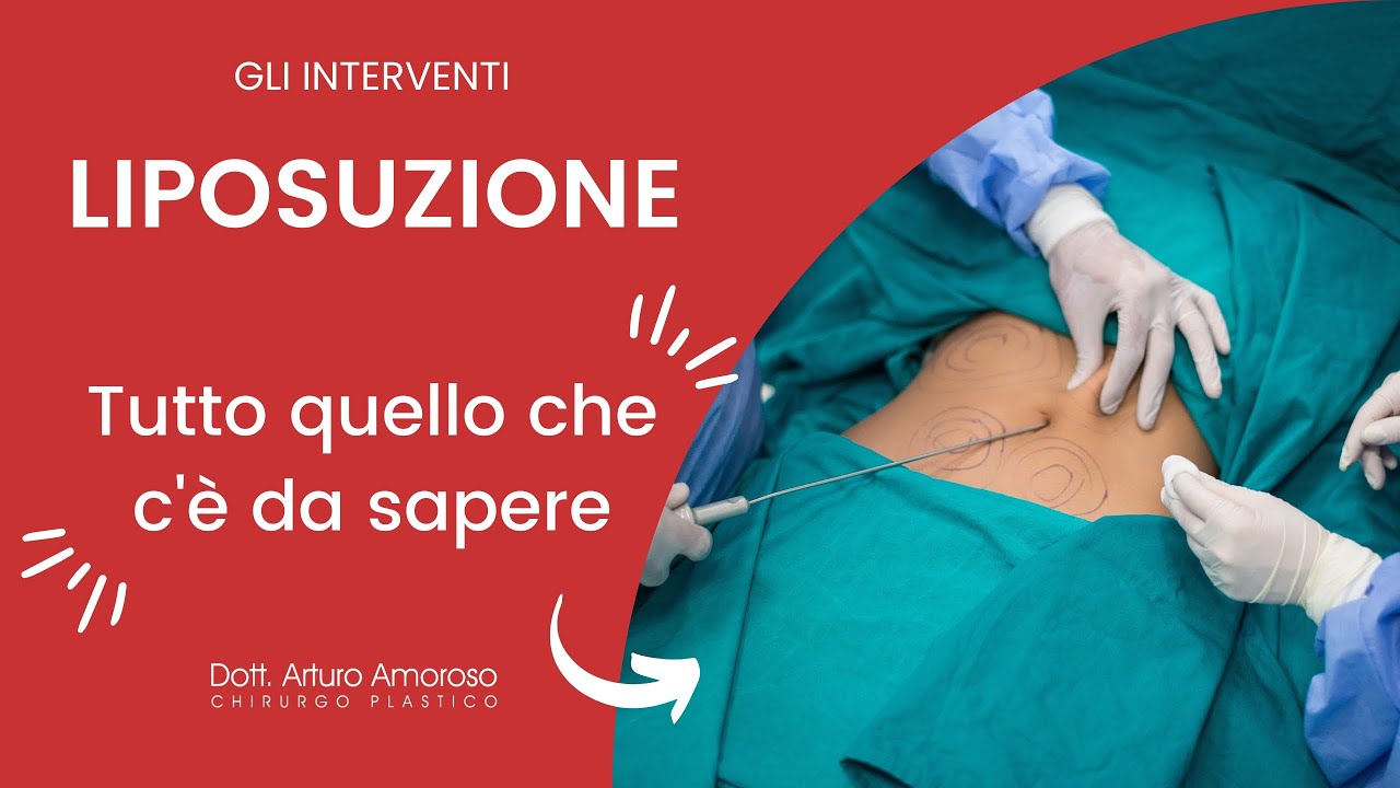 Liposuzione e Liposcultura - Dott. Arturo Amoroso