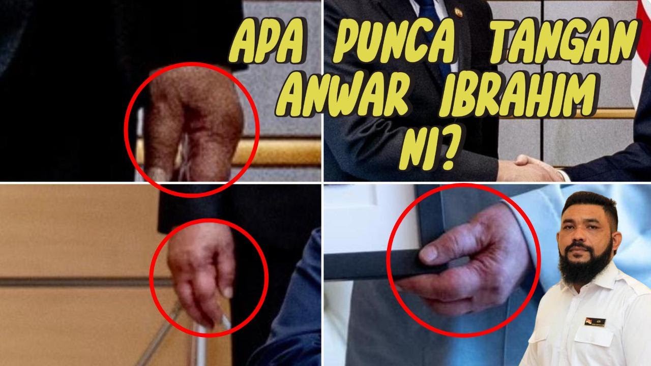 APA PUNCA TANGAN PMX NI? ADAKAH DISEBABKAN HIV AIDS? - YouTube