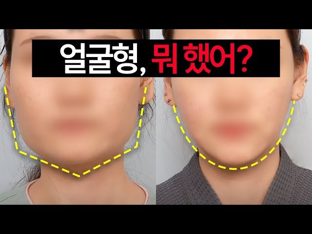 얼굴형, 뭐 했어?🙄 윤곽수술 전후 분석 (사각턱 + 광대축소)