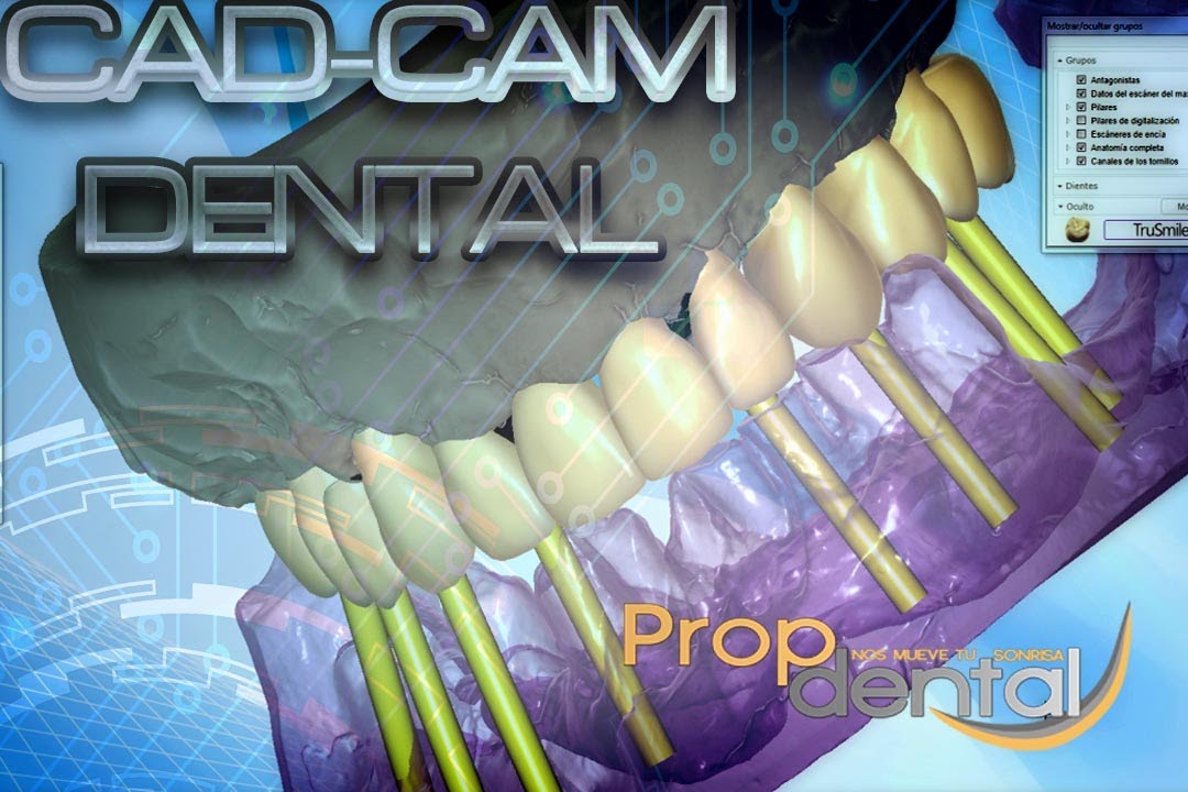 Cad cam dental - YouTube