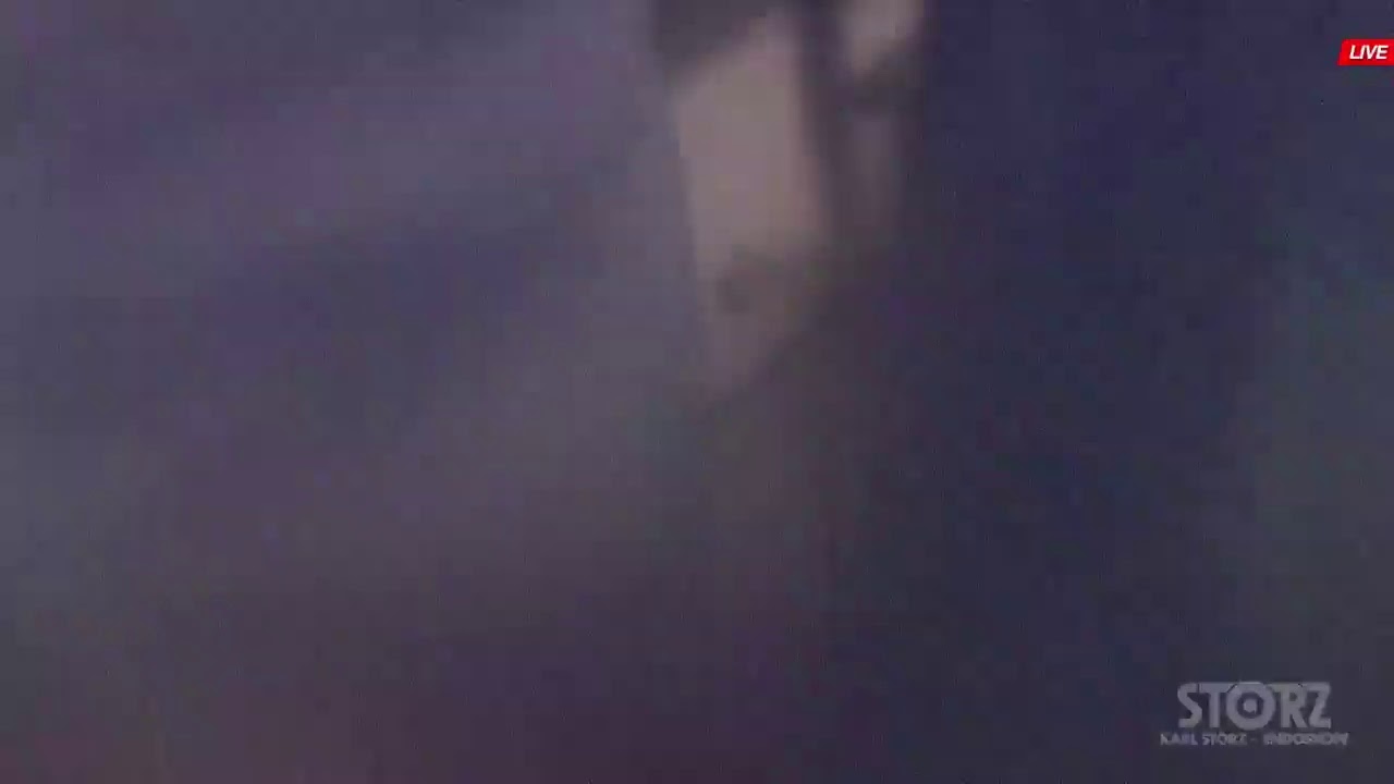 Лапарсокопическая передняя экзентерация органов малого таза, операция ...