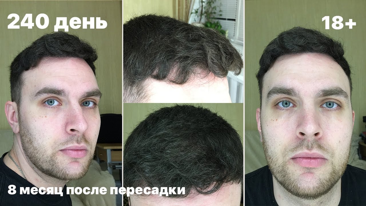 Пересадка волос в стамбуле. Трансплантация волос по месяцам. Месяц после пересадки волос. Пересадка волос в Турции. Три месяца после пересадки воло.