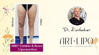 360° Cankle & Knee Surgery | Lipedema Liposuction | Artlipo | Expert Dr. George Kardashian