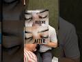 👁️ आंखों के पास पीले निशान? | Xanthelasma Treatment by RF Cautery #shorts #youtubeshorts #viral