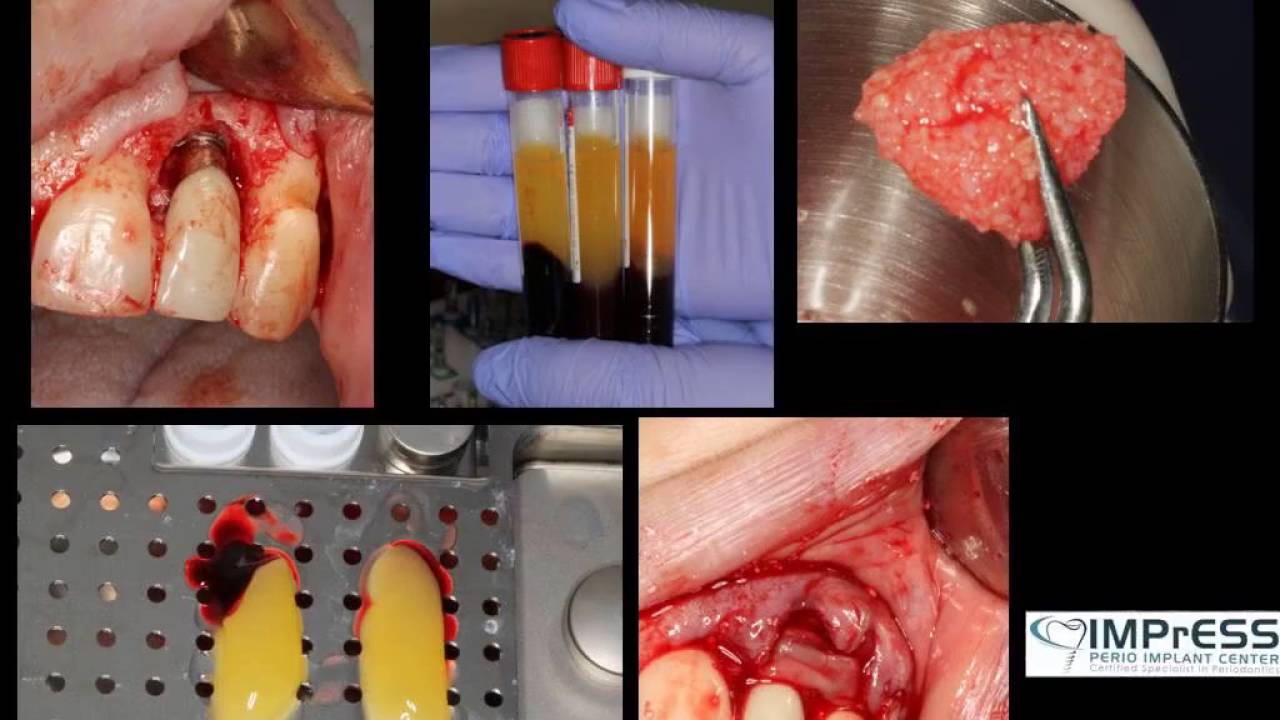 Peri-implantitis, Dental Implant Disease, Gingival Recession 