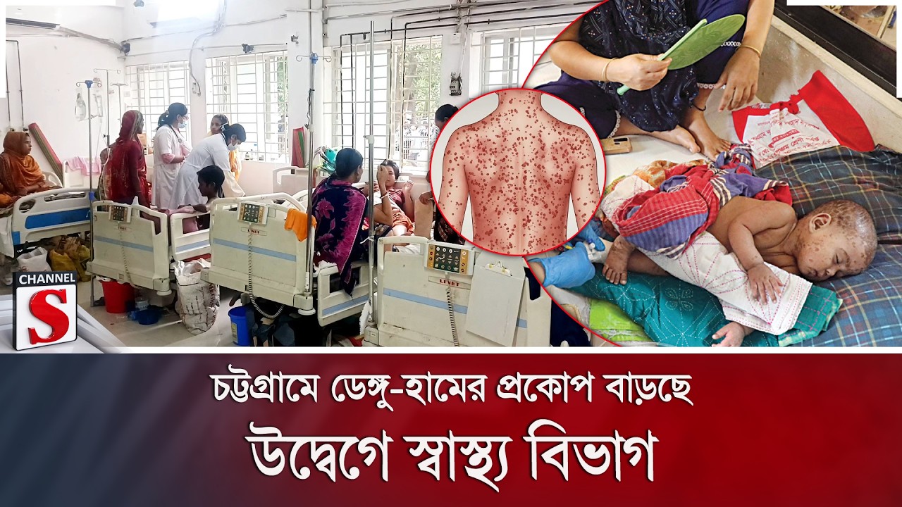 চট্টগ্রামে ডেঙ্গু-হামের প্রকোপ বাড়ছে; উদ্বেগে স্বাস্থ্য বিভাগ | Dengue | Measles | Channel S News
