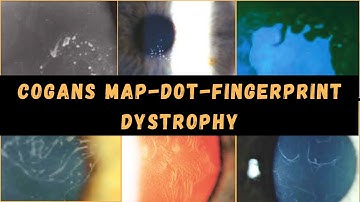 #2 Corneal dystrophy - Epithelial Basement Membrane Dystrophy (EBMD) | Map-Dot-Fingerprint Dystrophy