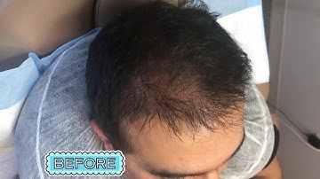 SMP Hairline Density Job!!! Scalp Allure