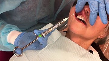 Infiltration Supraperiosteal Field Block