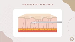 Subcision Treatment for Deep Acne Scars